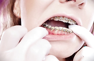 ASMR: upgraded braces with chain-link rubber bands together with nitrile gloves (Arya Grander)